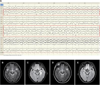 Case report: Pediatric anti-gamma aminobutyric acid-B receptor encephalitis with benign prognosis